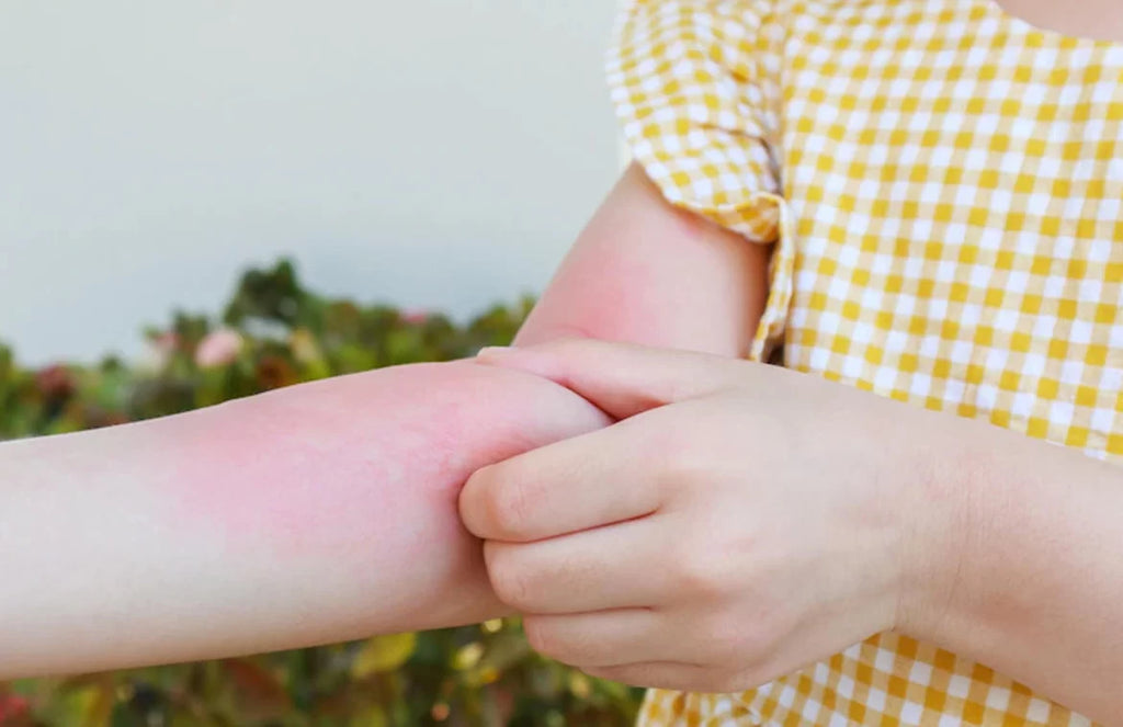 What Causes Skin Itchiness and How to Avoid them in Children