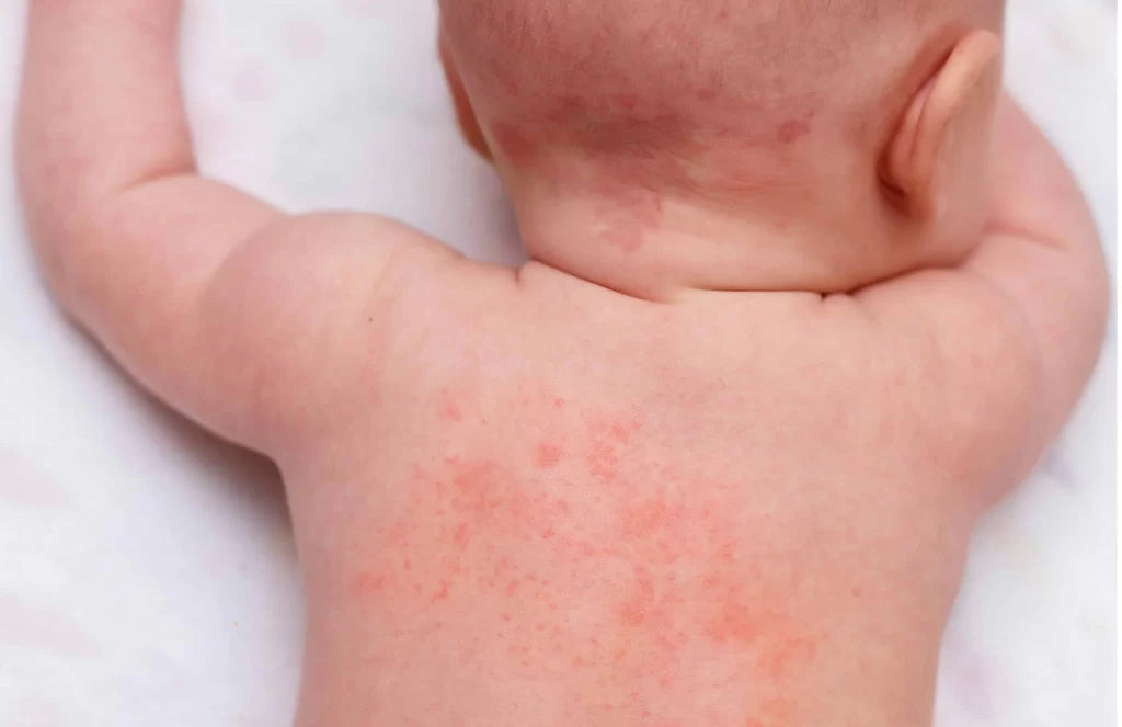Common Newborn Skin Conditions in Babies